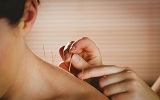 Woman receiving acupuncture on her shoulder